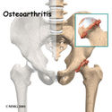 Hip Surgery-San Diego Orthopedic Surgery-Knee-Shoulder