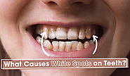 What Causes white spots on Teeth? Learn How To Get Rid of It!