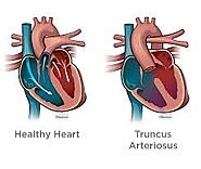 Learn more about Truncus Arteriosus