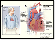 Congenital Heart Disease Treatment - Genesis Foundation