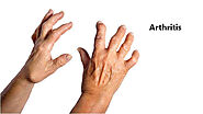 Know About Arthritis And Treatment Options