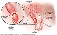 Know About Hernia Treatment and Why It Is Effective