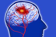 What Are The Telling Symptoms Of An Oncoming Brain Stroke?