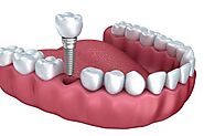 Top 7 Benefits Of Full Mouth Dental Implant
