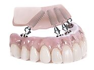 Dental Implants Plano TX