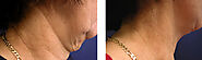 Where Can I Get Neck Lift Incision by Top Facelift Surgeons?