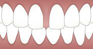 How to fix teeth gap naturally at home without braces?