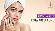 All You Need to Know About ACNE