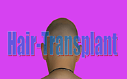 Hair Transplant Surgery: Procedure, Complications, Side Effects And More