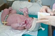 Study Finds Benefits in Delaying Severing of Umbilical Cord