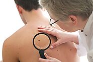 Skin Tag Removal Cream : How to Remove Skin Tags At Home, Causes