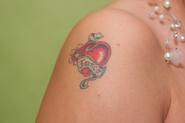 What are the Different Types of Tattoo Removal?