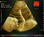 How Safe Is 4D Ultrasound?