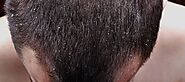 Can dandruff lead to hair loss? - New Jersey Hair Restoration Center