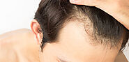 How Follicular Unit Extraction (FUE) Works
