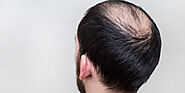 Hair Loss Can Hurt - What to do?
