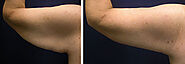 Chicago Arm Lift Surgery by Top Cosmetic Surgeon