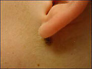 Get the Laser Mole Removal Services from Best Plastic Surgeon