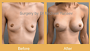 Here’s How You Can Become A Good Candidate For Breast Implant + Tips | by Breast & Body Clinic | Aug, 2020 | Medium