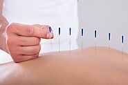Increase Your Overall Wellness With the Help of Acupuncture