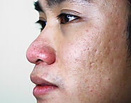 Subcision Acne Scar Treatment | Radium Medical Aesthetics in Singapore