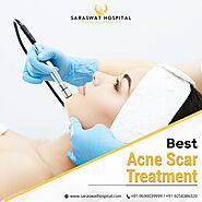 Which is the Best Acne Scar Treatment for a Patient?