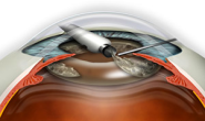 Cataract Surgery Guide - Cost, Recovery, Lens Options