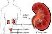 Kidney Stone Treatment 15 Home Remedies | Stone Natural Cure