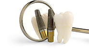 Best Dental Implant Clinic Zirakpur (Chandigarh) - SmileWide