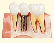 Dental Crowns - SmileWide Dental Clinic