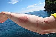Need to Know Jellyfish Sting Treatment