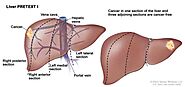 Natural Liver Cancer Treatments