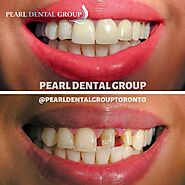 What Are the Benefits of Dental Bonding? - Pearl Dental Group