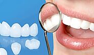 Dental Implants Vs. Veneers: Which Is Better to Restore Your Smile? - Pearl Dental Group