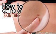 Skin Tag Removal Cream: How to Get Rid of Skin Tags on Face, Neck and Eyelids - Health Vital Tips