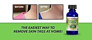 Endtag Skin Tag Remover : Does Hempvana Skin Tag Remover Work