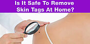 Skin Tag Home Remedies That Really Work, Skincare - Healthy Living