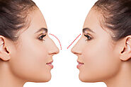 Can a Nose job Make you more Attractive 