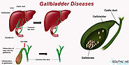 Gallbladder Diseases- Overview, Types and Diagnosis- Southlake Texas