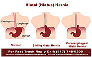 Hernia Problem- Cause, Types, Symptoms, Diagnosis & Treatment | Texas
