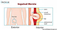 Inguinal hernia- Causes, Types, Symptoms, Diagnose & Treatment | Texas