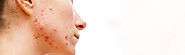 Acne: FAQs and Treatment Options