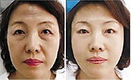 Always keep your face refresh with Non-surgical face lift Sydney - xara skin clinic