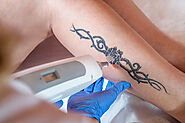 Readily erase tattoo with laser tattoo removal Sydney - xara skin clinic