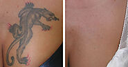 Clearing regret tattoos with Laser tattoo removal Sydney – Xara Skin Clinic