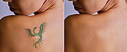 Expunge unwearable tattoos with Laser Tattoo Removal Sydney - xara skin clinic