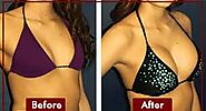 BRAVA Breast Augmentation in Dubai, Abu Dhabi & Sharjah - Cost & Offers