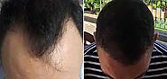 Hair Restoration in Dubai, Abu Dhabi & Sharjah | Hair Regrowth Cost