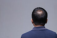 Why A Hair Transplant Doesn’t Come Cheap? - Dr Tyng Tan