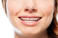 Clear Braces Guide: Information on Types, Costs and More in the UK